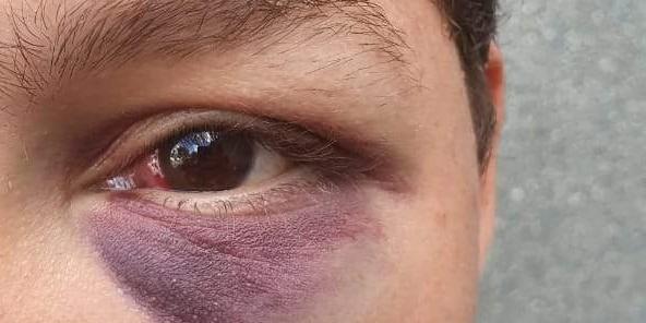 Grávida agredida por policial ficou com o olho roxo (Marco Antonio dos Santos/Arquivo)